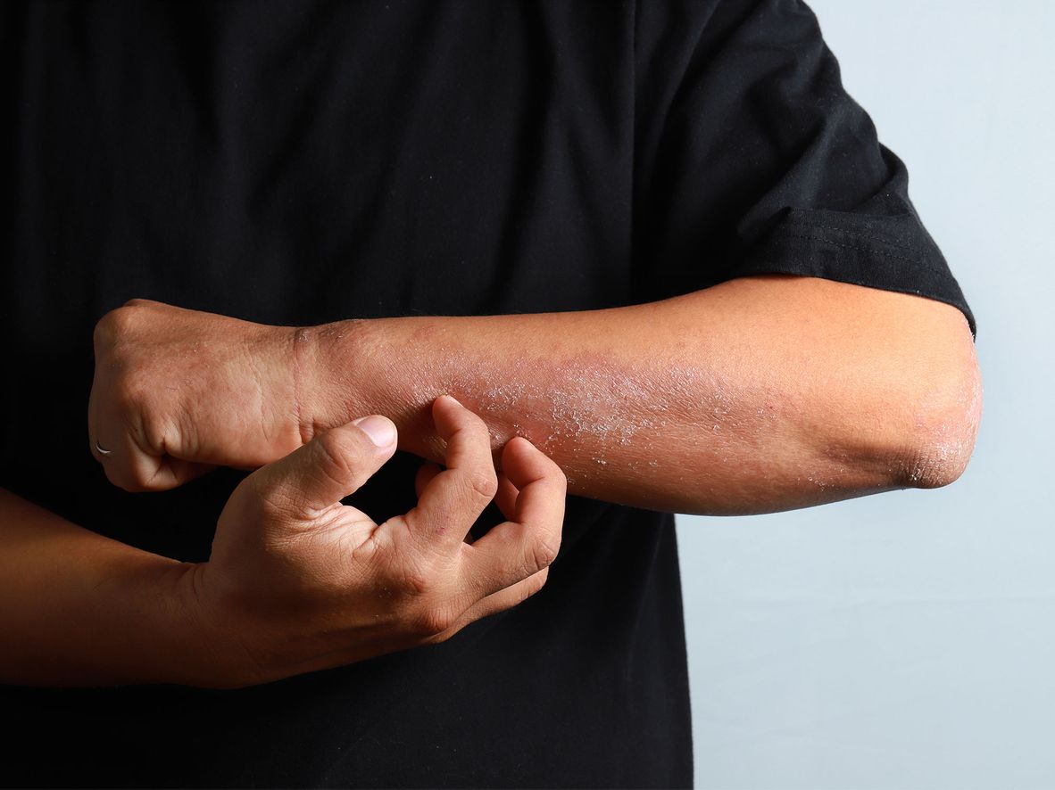 Eczema on the forearm of someone with brown skin.