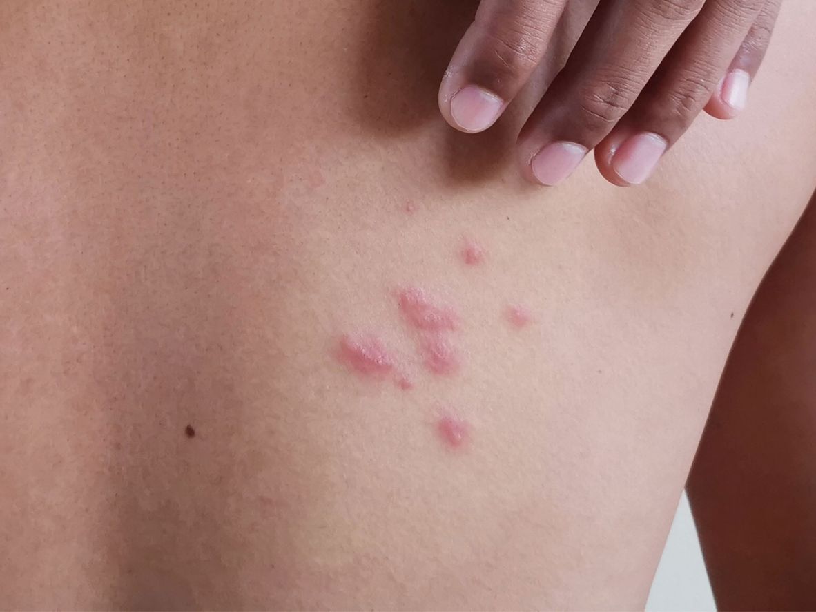 Heat rash on brown skin.