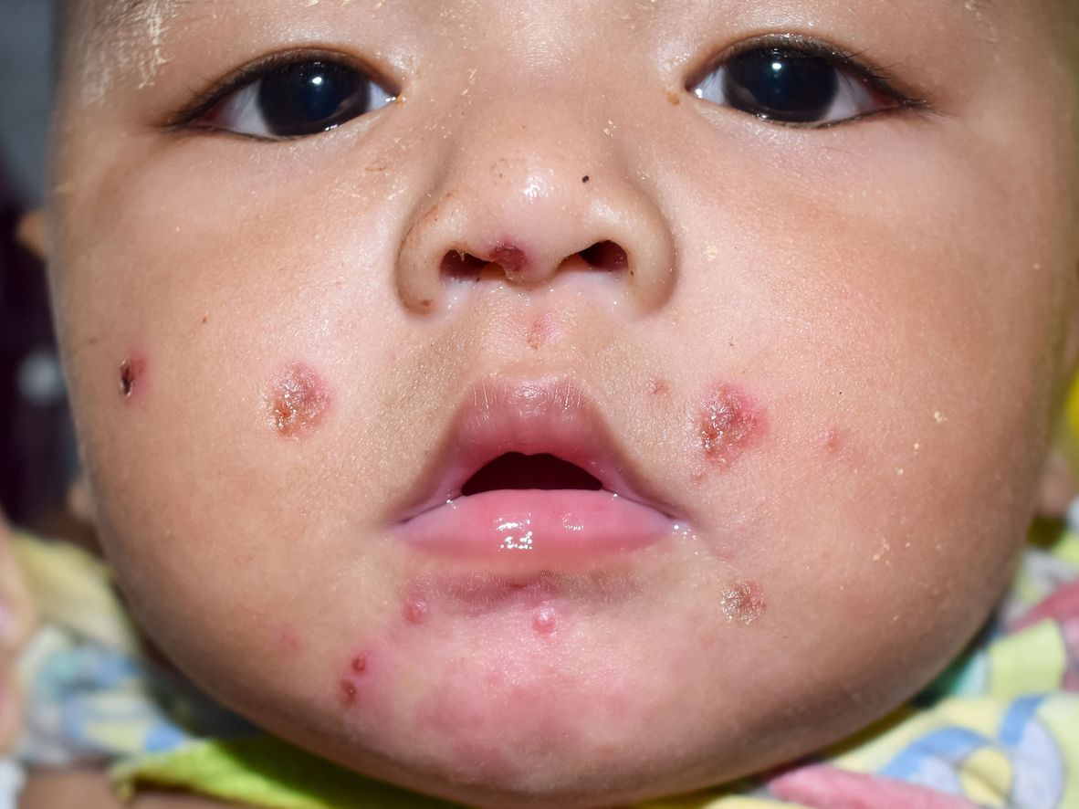 Impetigo on brown skin.
