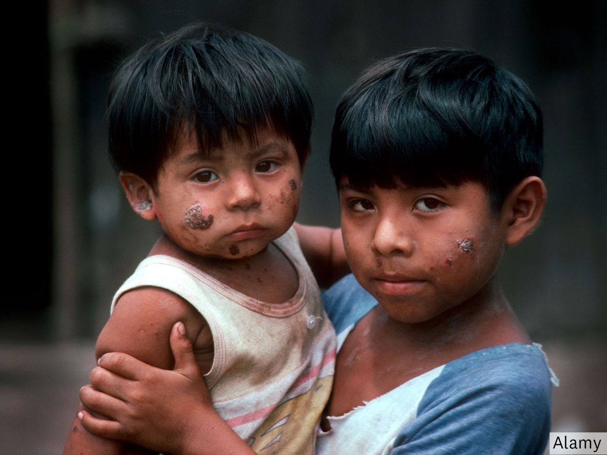 Impetigo on the faces of children with brown skin.