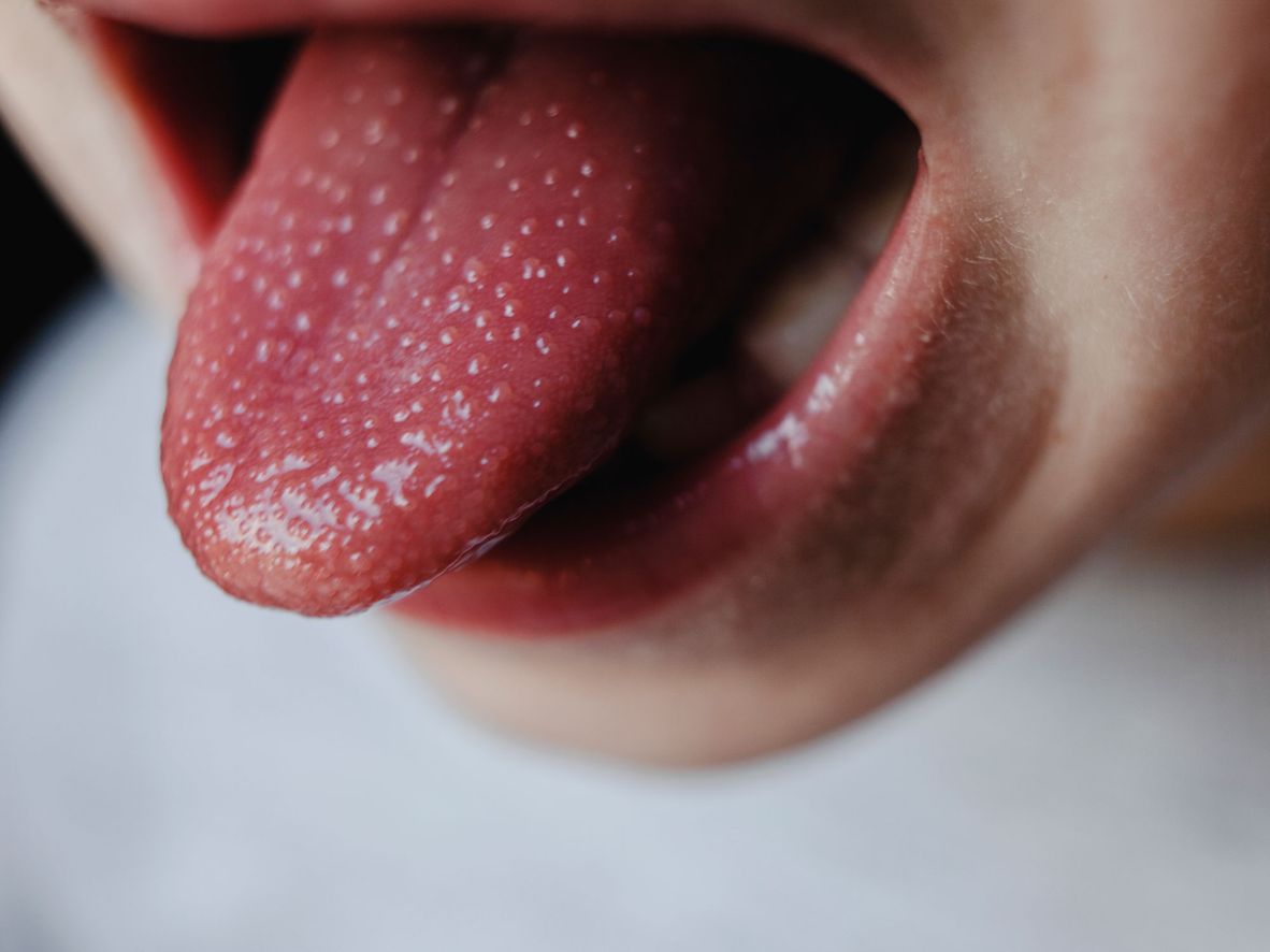 The tell-tale 'strawberry tongue' of scarlet fever.